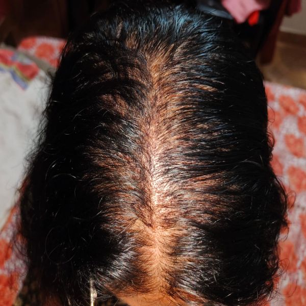 Female androgenetic alopecia of male pattern (FAGA.M)-